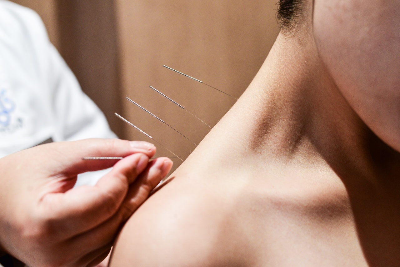 TCM Acupuncture
