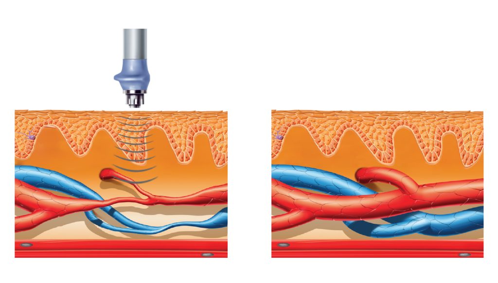 Radial Shockwave Therapy (RSWT)