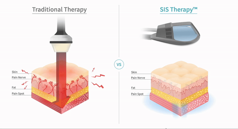 sis super inductive system how it works