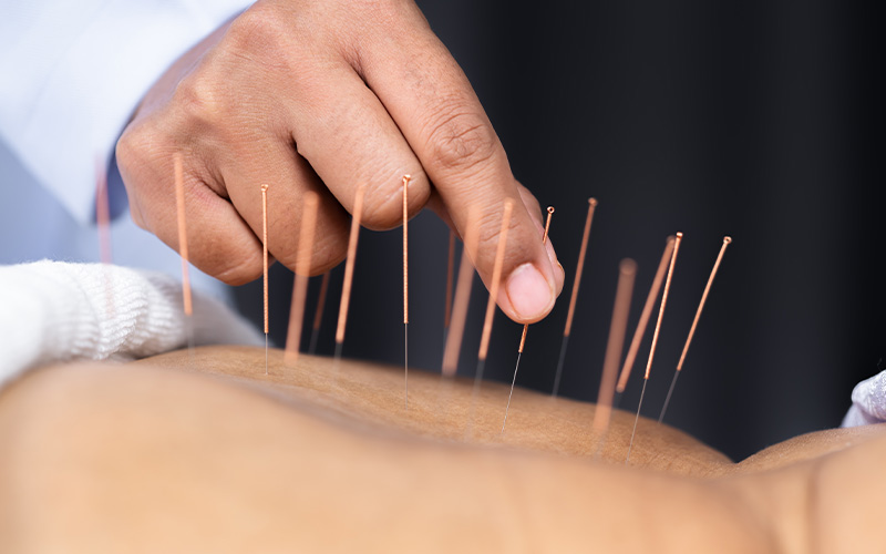 Practitioner administering acupuncture for chronic back pain at 1TCM.