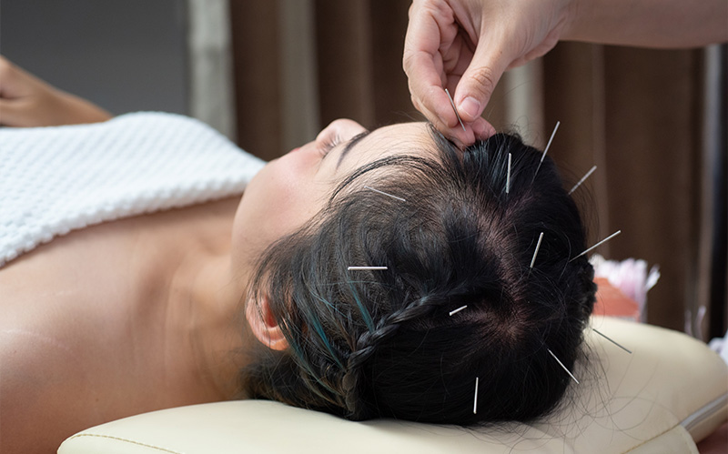 Scalp acupuncture treatment for hair growth.