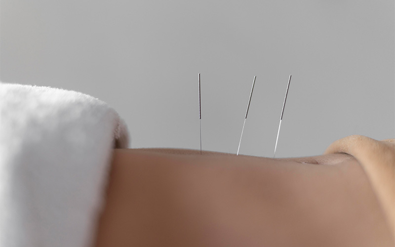 Close-up of acupuncture needles in skin.